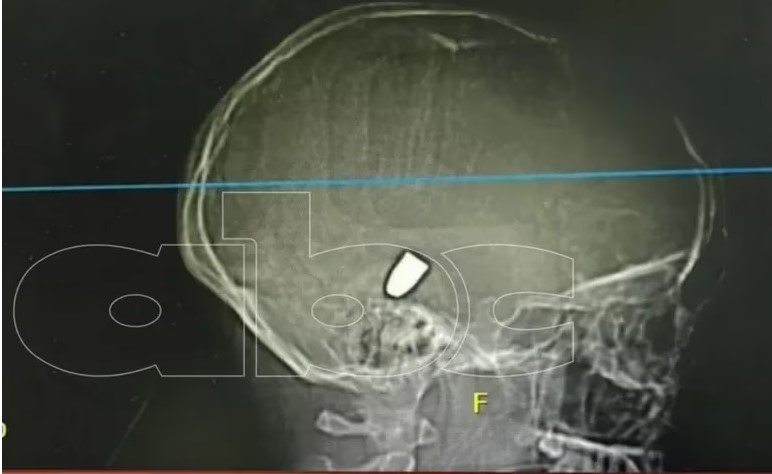 Niña víctima de bala perdida con pronostico reservado