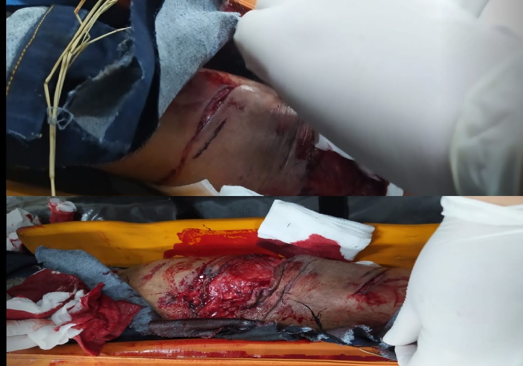 Conductor huye tras grave accidente sobre la Línea Internacional dejando a dos heridos