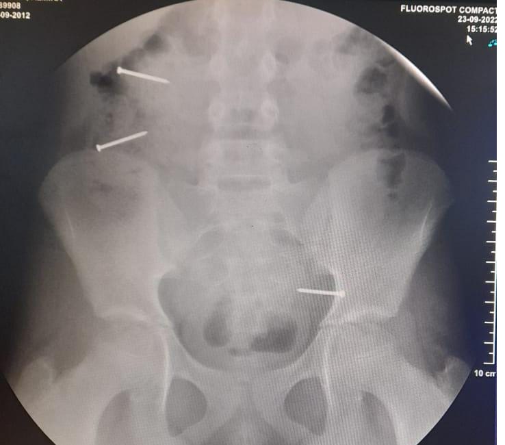 Concepción: Niña de 10 años realizaba un desafío de TikTok, se tragó tres clavos y terminó internada