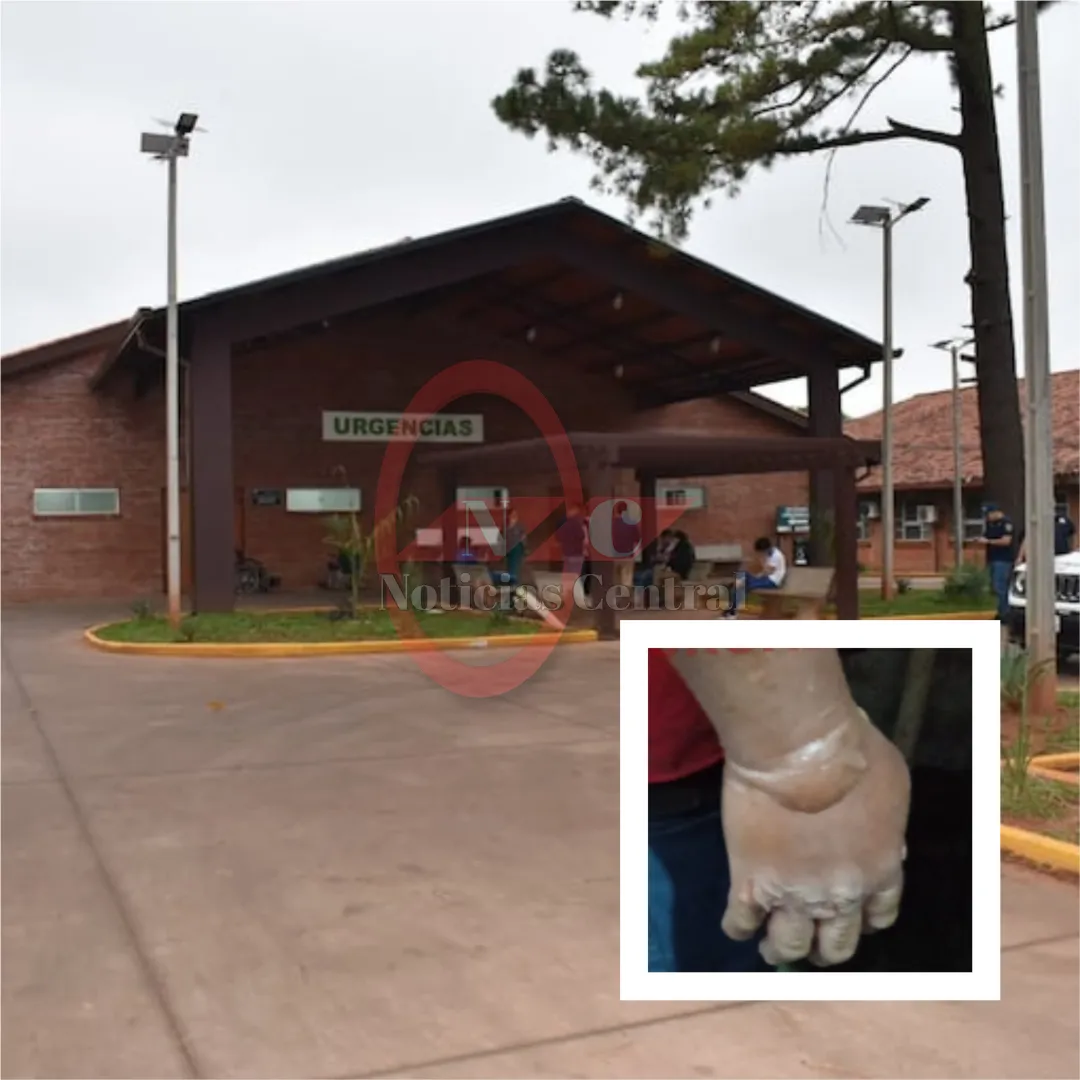 Explosión de garrafa deja a un hombre con graves quemaduras en Zanja Pytã